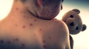 Japan reports more than 400 measles cases since January